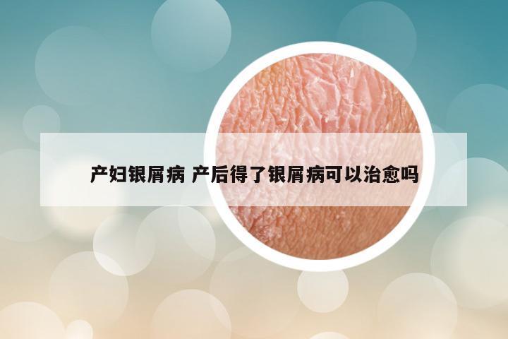 产妇银屑病 产后得了银屑病可以治愈吗