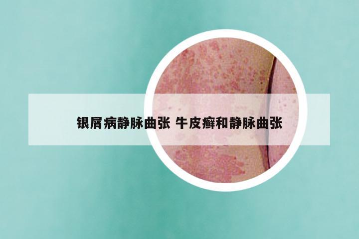 银屑病静脉曲张 牛皮癣和静脉曲张