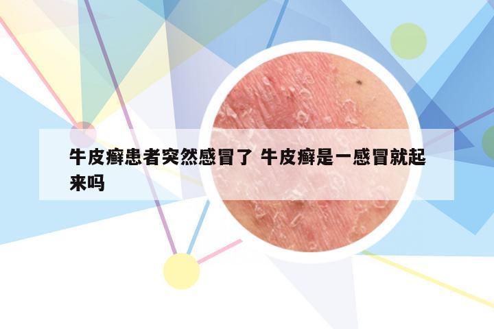 牛皮癣患者突然感冒了 牛皮癣是一感冒就起来吗