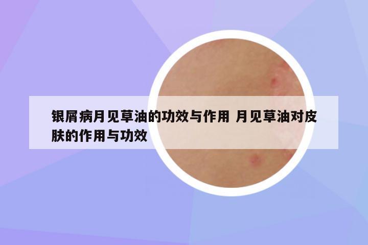 银屑病月见草油的功效与作用 月见草油对皮肤的作用与功效