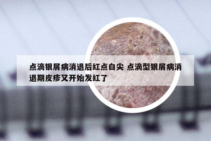 点滴银屑病消退后红点白尖 点滴型银屑病消退期皮疹又开始发红了