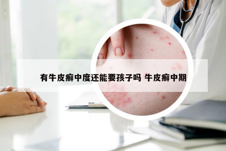 有牛皮癣中度还能要孩子吗 牛皮癣中期