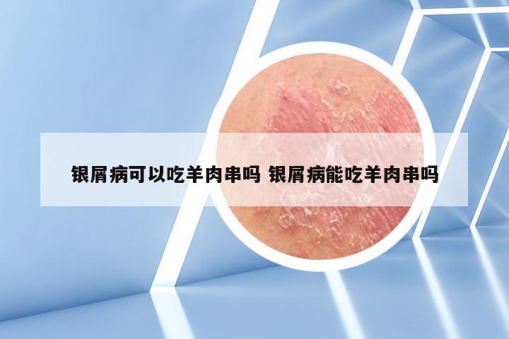 银屑病可以吃羊肉串吗 银屑病能吃羊肉串吗