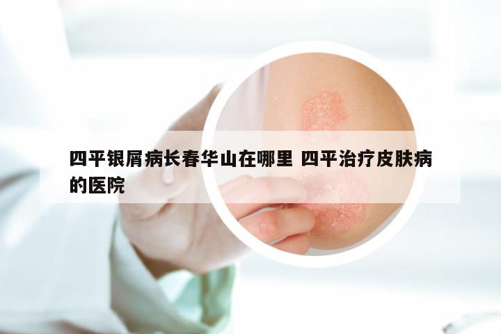 四平银屑病长春华山在哪里 四平治疗皮肤病的医院
