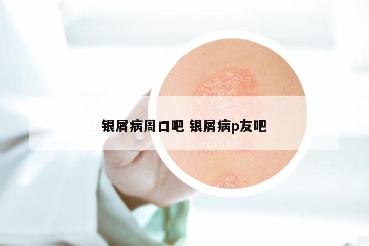 银屑病周口吧 银屑病p友吧