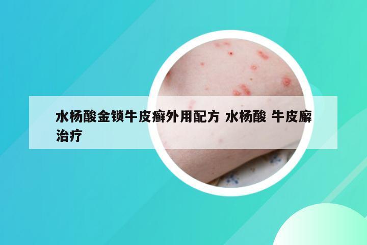 水杨酸金锁牛皮癣外用配方 水杨酸 牛皮廨治疗