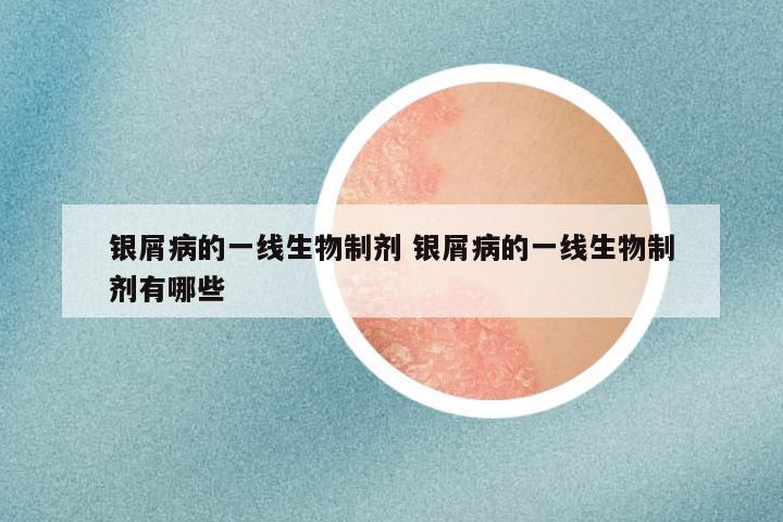银屑病的一线生物制剂 银屑病的一线生物制剂有哪些