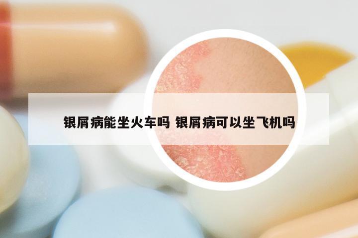 银屑病能坐火车吗 银屑病可以坐飞机吗