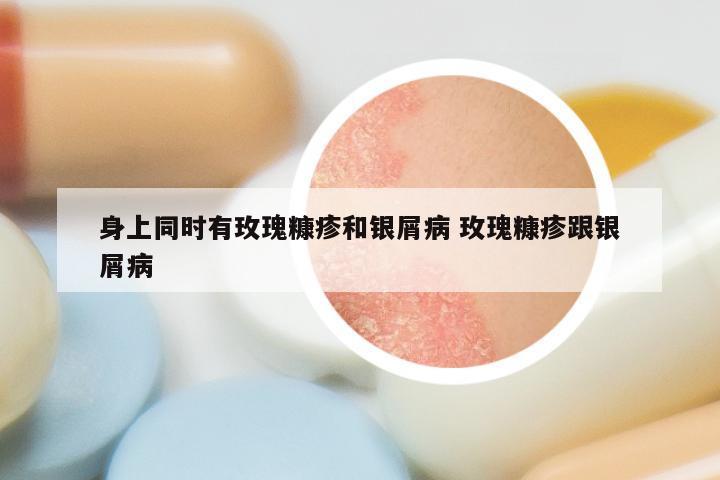 身上同时有玫瑰糠疹和银屑病 玫瑰糠疹跟银屑病