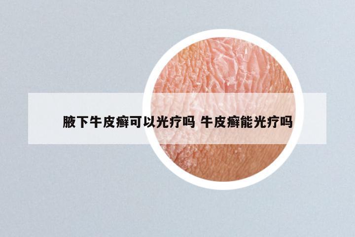 腋下牛皮癣可以光疗吗 牛皮癣能光疗吗