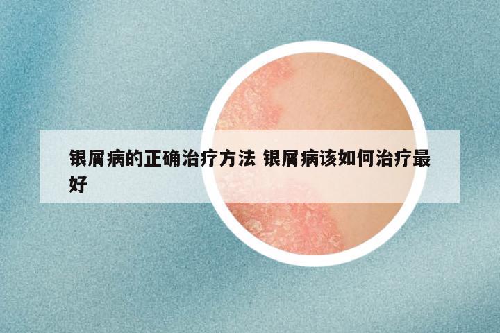银屑病的正确治疗方法 银屑病该如何治疗最好
