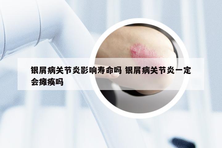 银屑病关节炎影响寿命吗 银屑病关节炎一定会瘫痪吗