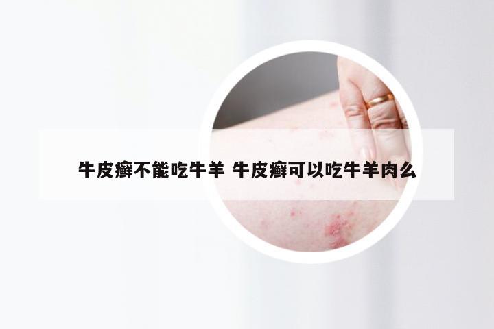 牛皮癣不能吃牛羊 牛皮癣可以吃牛羊肉么