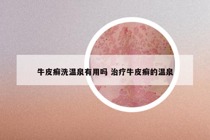 牛皮癣洗温泉有用吗 治疗牛皮癣的温泉