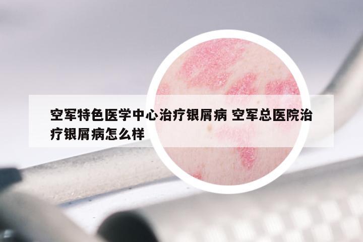 空军特色医学中心治疗银屑病 空军总医院治疗银屑病怎么样