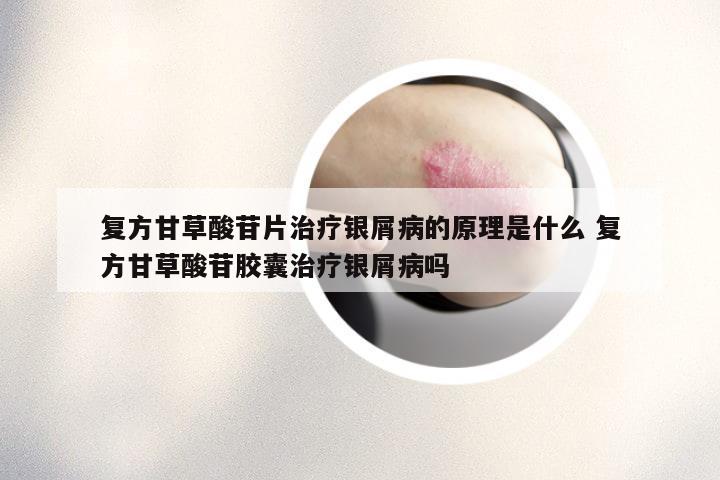 复方甘草酸苷片治疗银屑病的原理是什么 复方甘草酸苷胶囊治疗银屑病吗