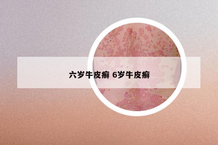 六岁牛皮癣 6岁牛皮癣