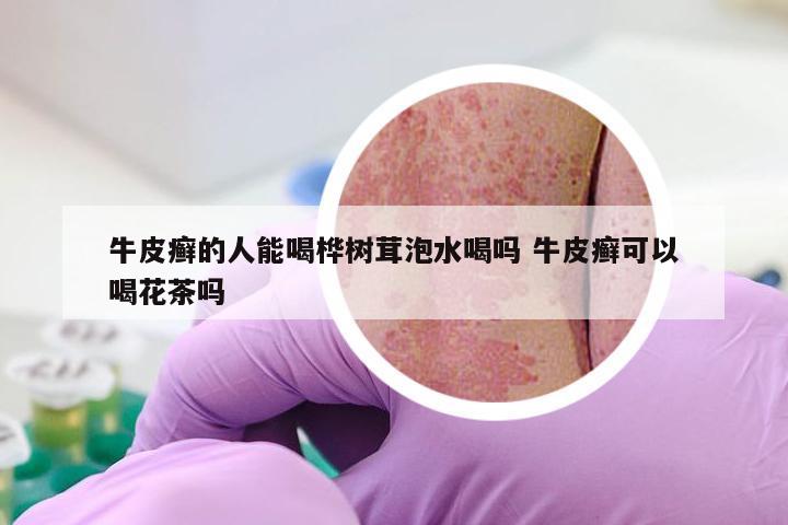 牛皮癣的人能喝桦树茸泡水喝吗 牛皮癣可以喝花茶吗