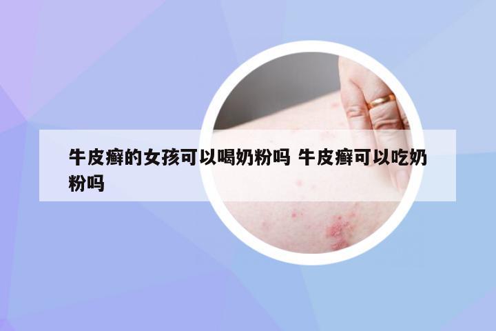 牛皮癣的女孩可以喝奶粉吗 牛皮癣可以吃奶粉吗