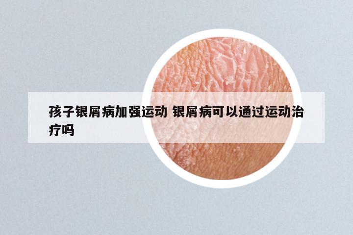 孩子银屑病加强运动 银屑病可以通过运动治疗吗