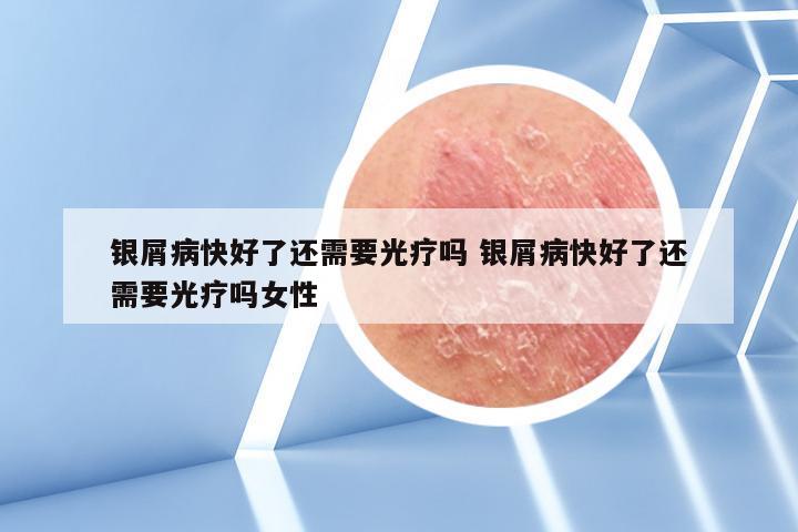 银屑病快好了还需要光疗吗 银屑病快好了还需要光疗吗女性