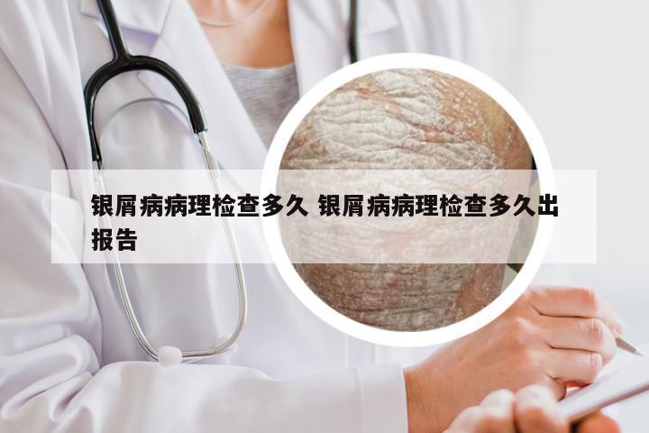 银屑病病理检查多久 银屑病病理检查多久出报告