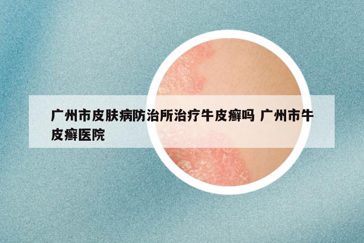 广州市皮肤病防治所治疗牛皮癣吗 广州市牛皮癣医院