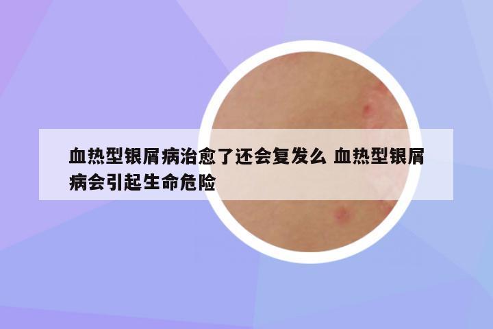 血热型银屑病治愈了还会复发么 血热型银屑病会引起生命危险