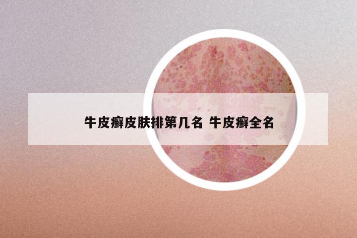 牛皮癣皮肤排第几名 牛皮癣全名