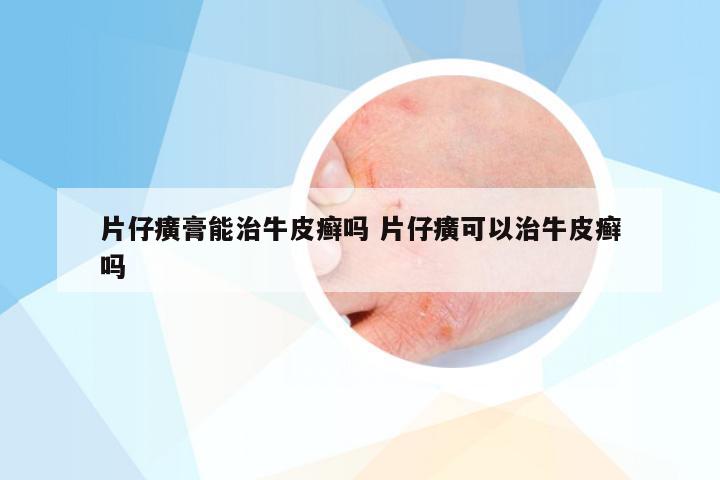 片仔癀膏能治牛皮癣吗 片仔癀可以治牛皮癣吗