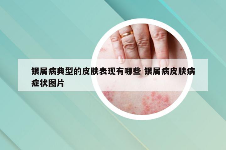 银屑病典型的皮肤表现有哪些 银屑病皮肤病症状图片