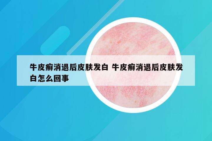 牛皮癣消退后皮肤发白 牛皮癣消退后皮肤发白怎么回事