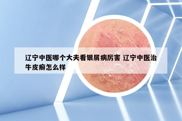 辽宁中医哪个大夫看银屑病厉害 辽宁中医治牛皮癣怎么样
