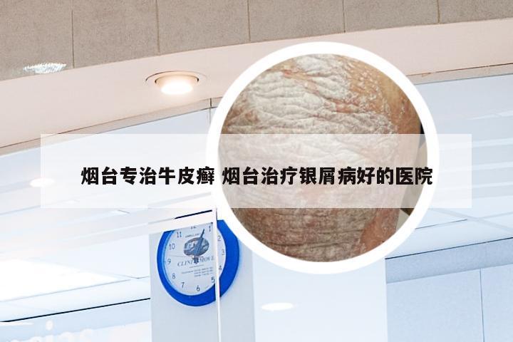 烟台专治牛皮癣 烟台治疗银屑病好的医院