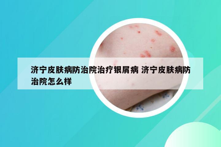 济宁皮肤病防治院治疗银屑病 济宁皮肤病防治院怎么样