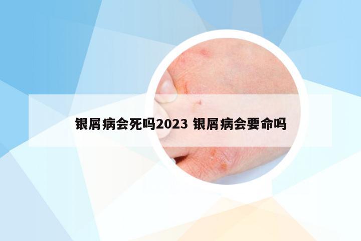 银屑病会死吗2023 银屑病会要命吗