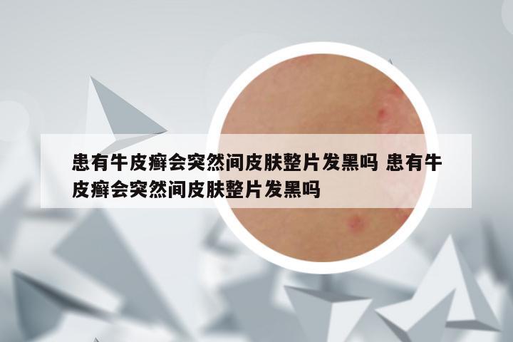 患有牛皮癣会突然间皮肤整片发黑吗 患有牛皮癣会突然间皮肤整片发黑吗
