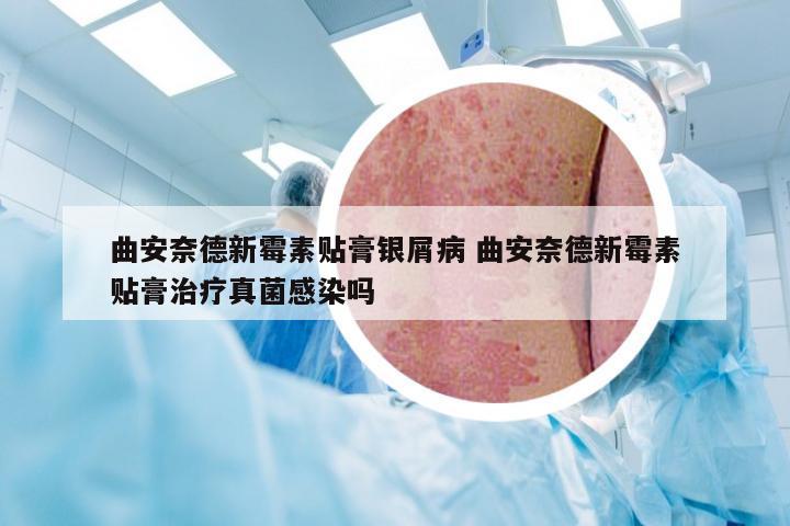 曲安奈德新霉素贴膏银屑病 曲安奈德新霉素贴膏治疗真菌感染吗