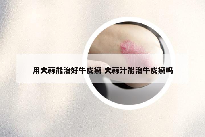 用大蒜能治好牛皮癣 大蒜汁能治牛皮癣吗