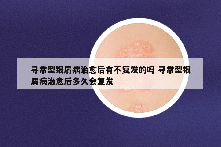 寻常型银屑病治愈后有不复发的吗 寻常型银屑病治愈后多久会复发