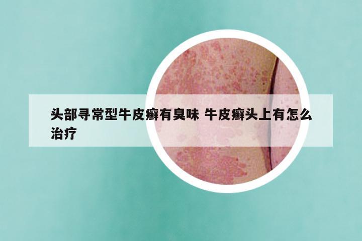 头部寻常型牛皮癣有臭味 牛皮癣头上有怎么治疗