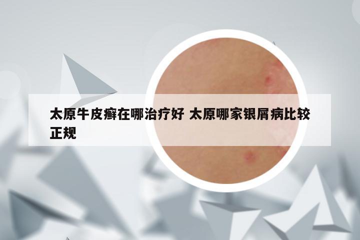 太原牛皮癣在哪治疗好 太原哪家银屑病比较正规