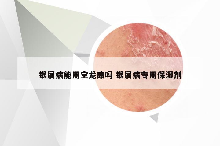 银屑病能用宝龙康吗 银屑病专用保湿剂