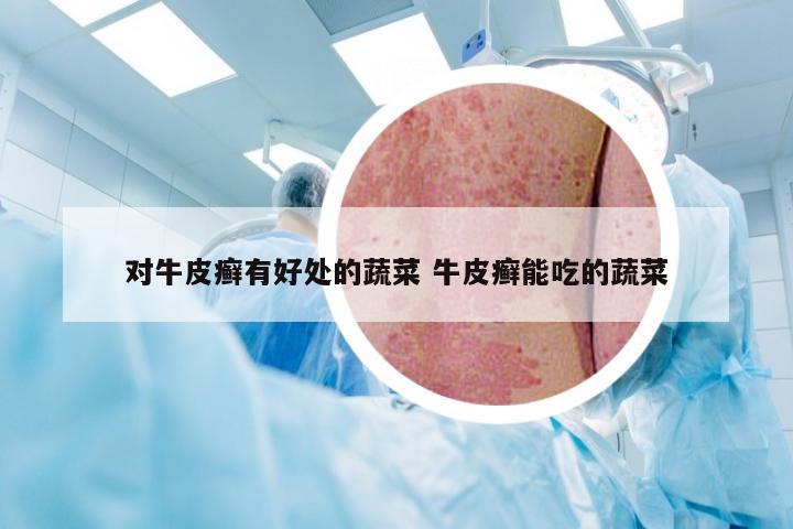 对牛皮癣有好处的蔬菜 牛皮癣能吃的蔬菜