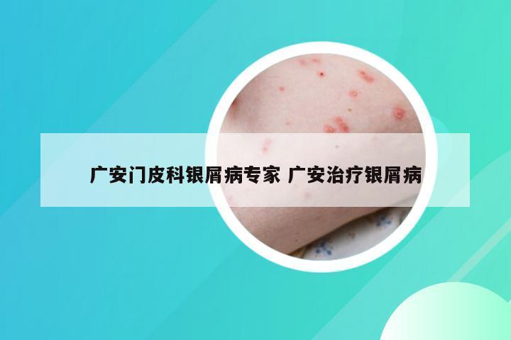 广安门皮科银屑病专家 广安治疗银屑病