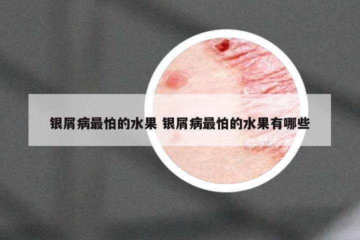 银屑病最怕的水果 银屑病最怕的水果有哪些