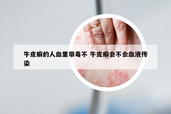 牛皮癣的人血里带毒不 牛皮癣会不会血液传染