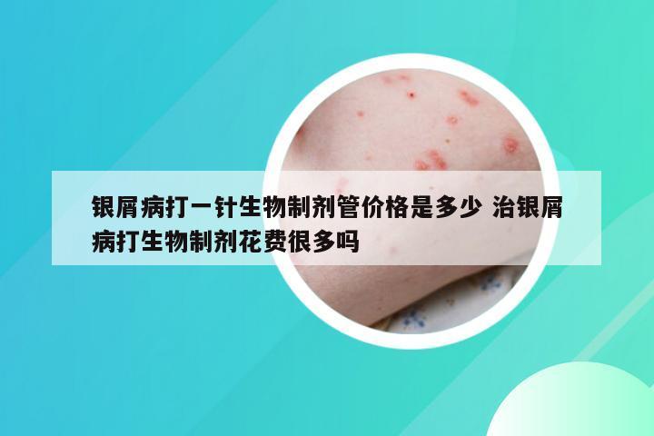 银屑病打一针生物制剂管价格是多少 治银屑病打生物制剂花费很多吗