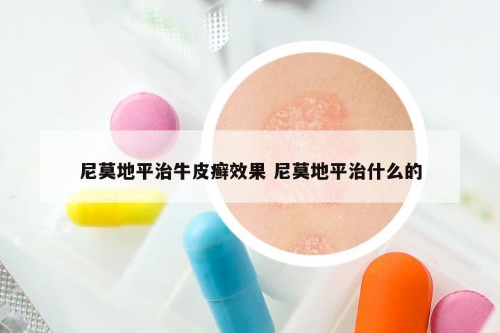尼莫地平治牛皮癣效果 尼莫地平治什么的