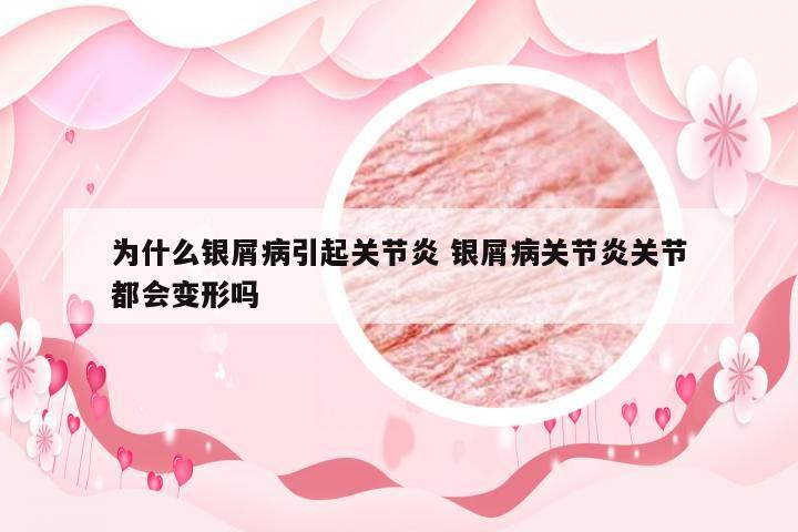 为什么银屑病引起关节炎 银屑病关节炎关节都会变形吗